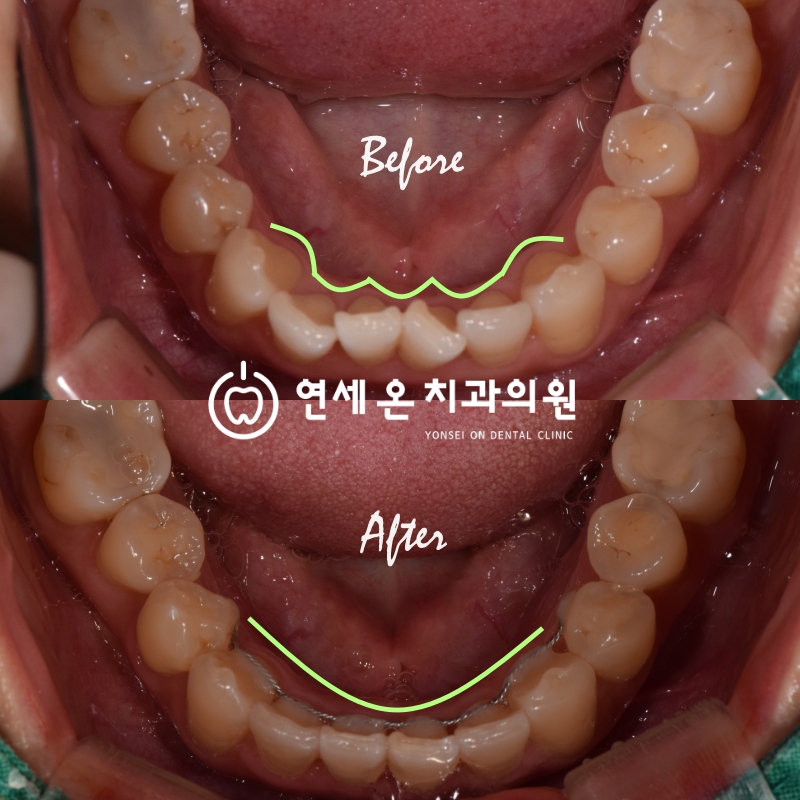 중장년 앞니교정, 나이는 이제 제약이 아닙니다 — 김경희 대표원장