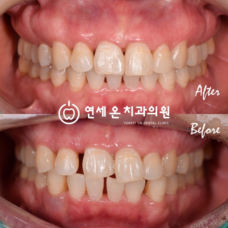 중장년층투명교정