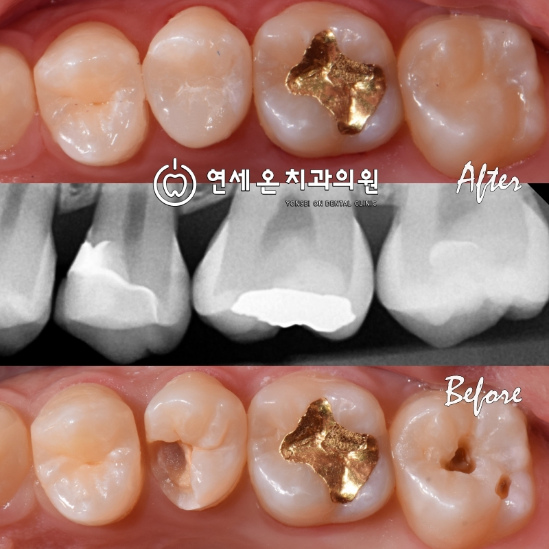 이맥스온레이(E.max onlay)수복