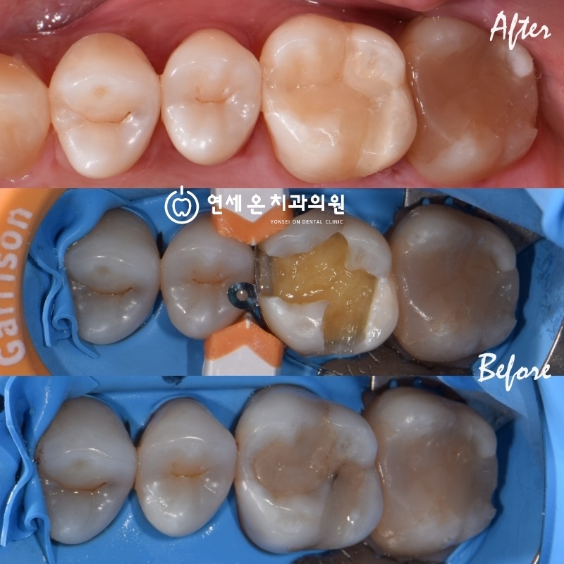 연세온치과 접착수복 실제 케이스 — 러버댐 방습 하 다수 구치부를 직접 레진으로 자연 색조 수복한 Before/After